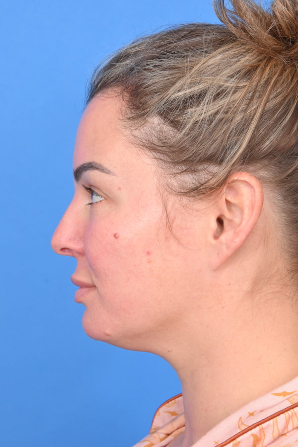 Neck Liposuction Before & After Image