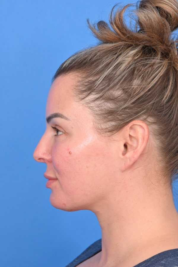 Neck Liposuction Before & After Image