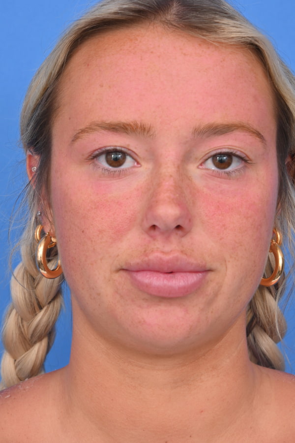 Neck Liposuction Before & After Image