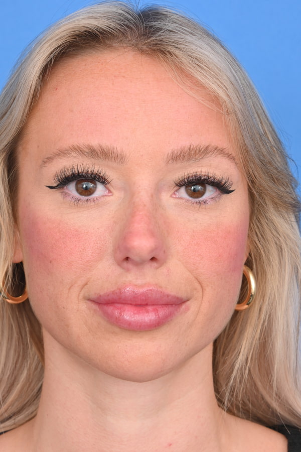 Neck Liposuction Before & After Image