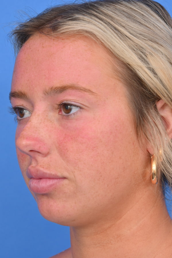 Neck Liposuction Before & After Image