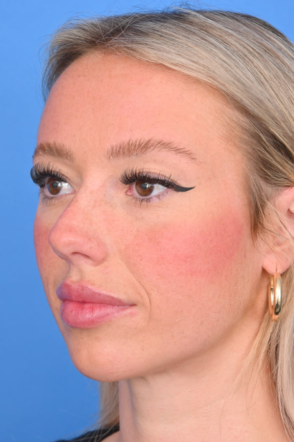 Neck Liposuction Before & After Image