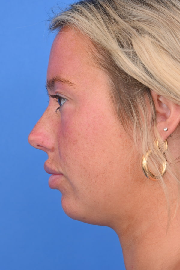 Neck Liposuction Before & After Image