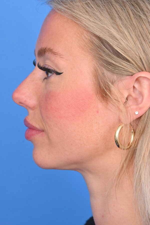 Neck Liposuction Before & After Image