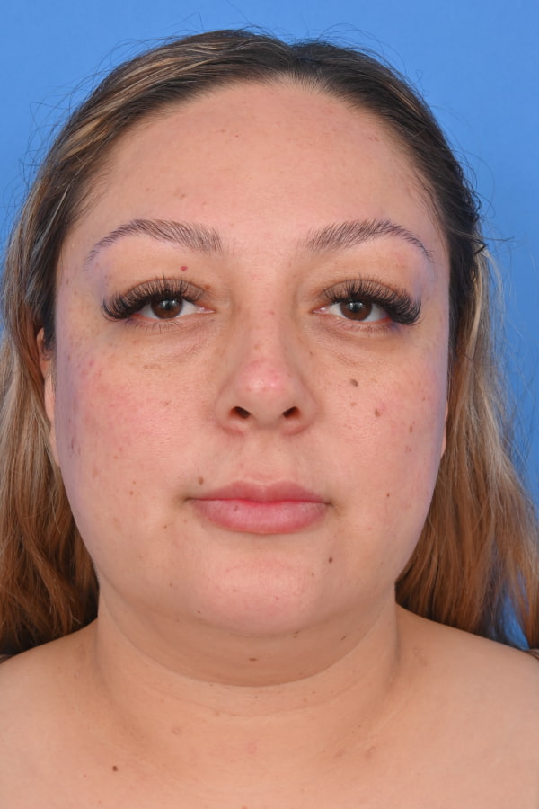 Neck Liposuction Before & After Image