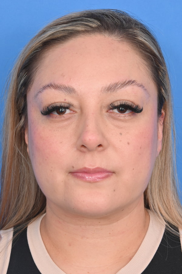 Neck Liposuction Before & After Image