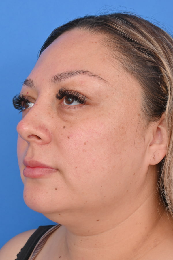Neck Liposuction Before & After Image
