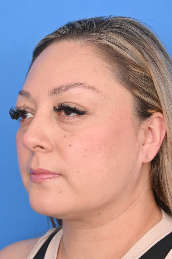 Neck Liposuction Before & After Image