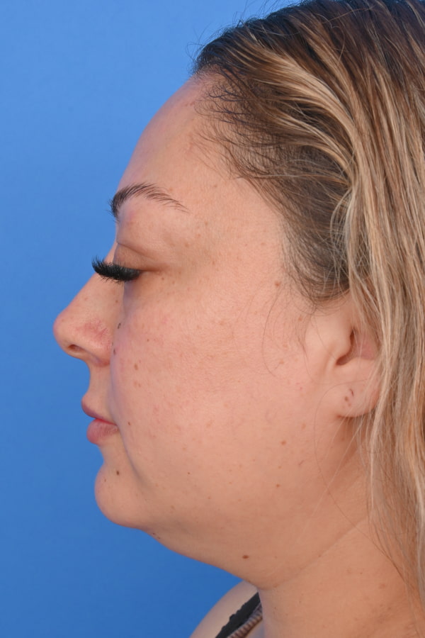 Neck Liposuction Before & After Image