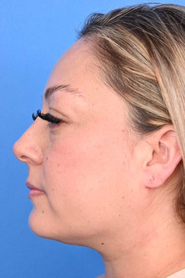 Neck Liposuction Before & After Image