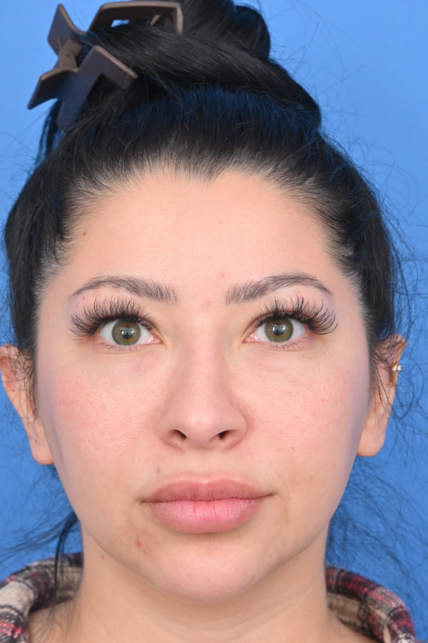 Neck Liposuction Before & After Image