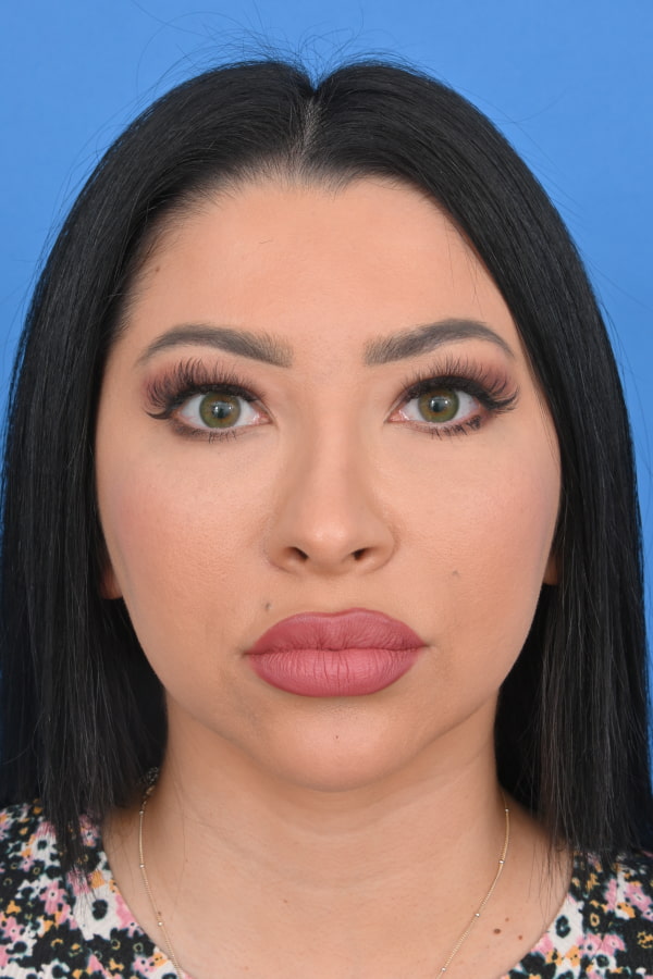 Neck Liposuction Before & After Image