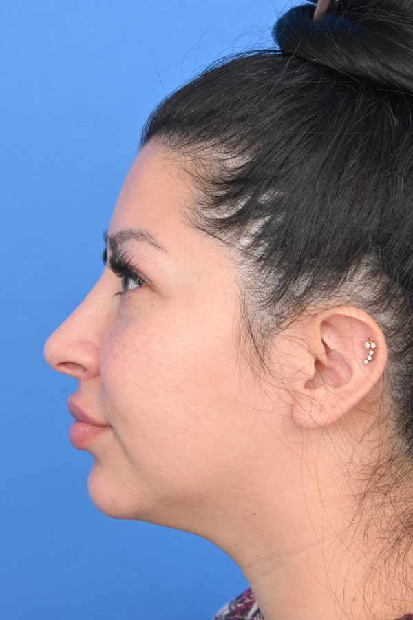 Neck Liposuction Before & After Image
