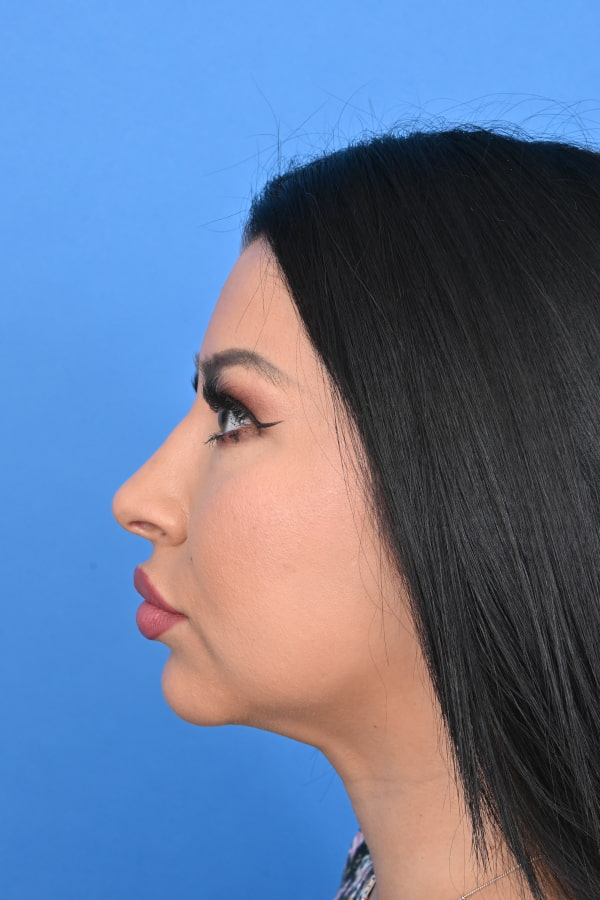 Neck Liposuction Before & After Image