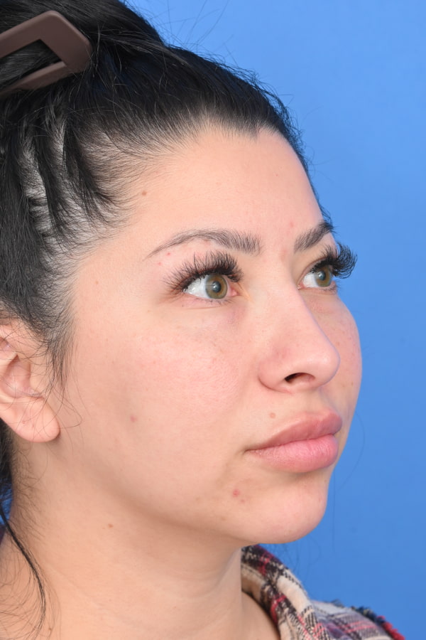 Neck Liposuction Before & After Image