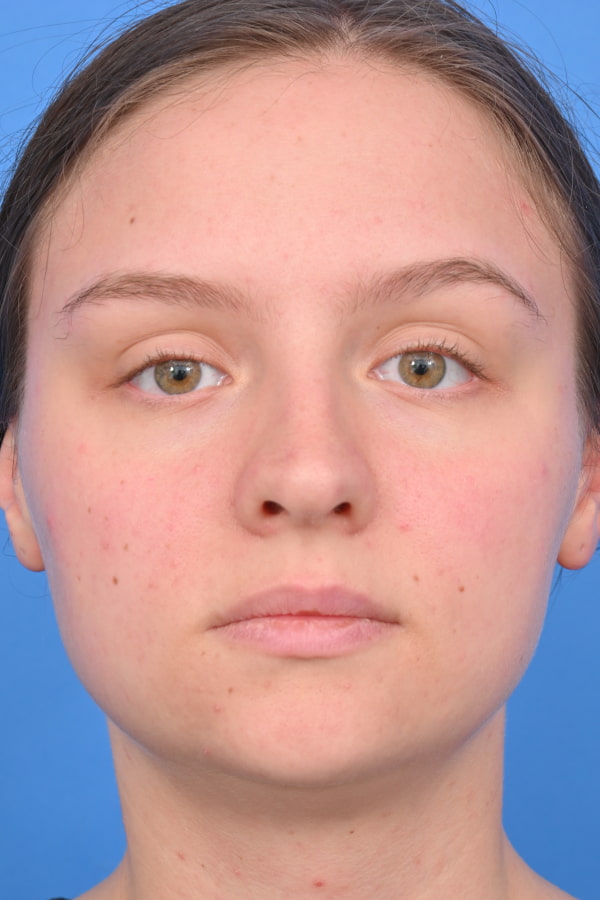 Neck Liposuction Before & After Image