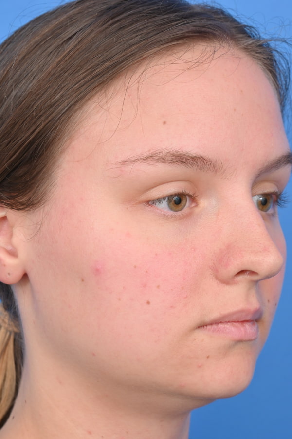 Neck Liposuction Before & After Image