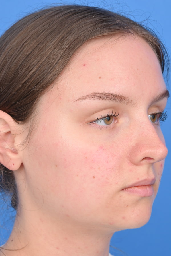 Neck Liposuction Before & After Image