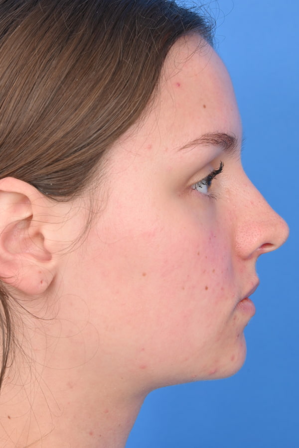 Neck Liposuction Before & After Image