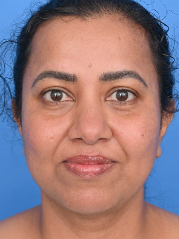 Neck Liposuction Before & After Image