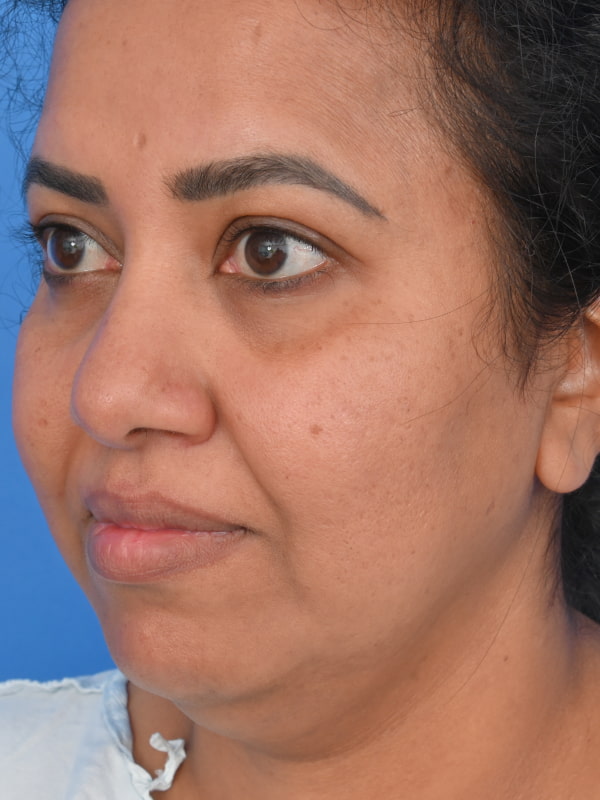 Neck Liposuction Before & After Image