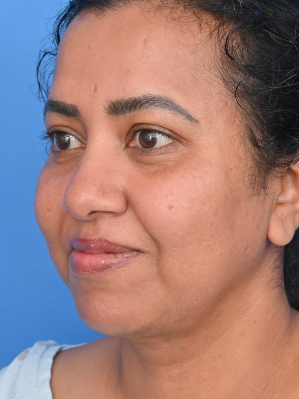 Neck Liposuction Before & After Image