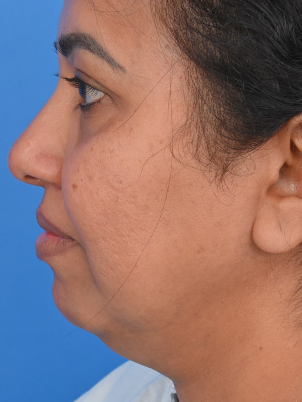 Neck Liposuction Before & After Image