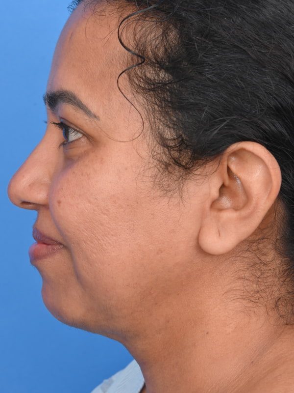 Neck Liposuction Before & After Image