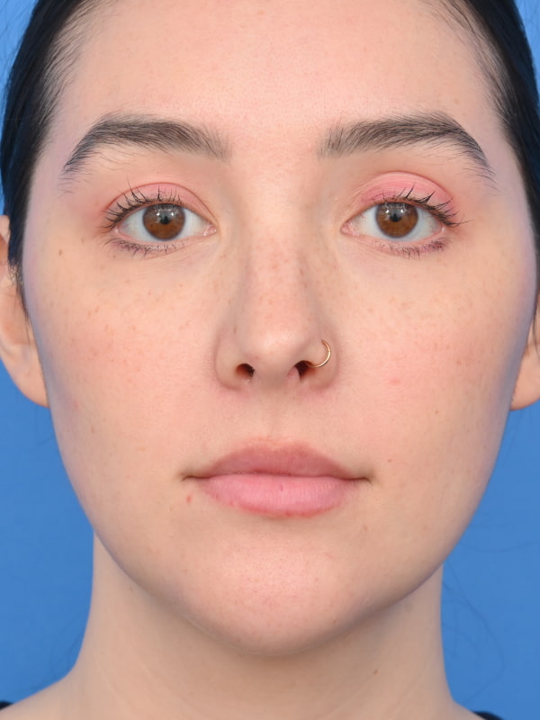 Neck Liposuction Before & After Image