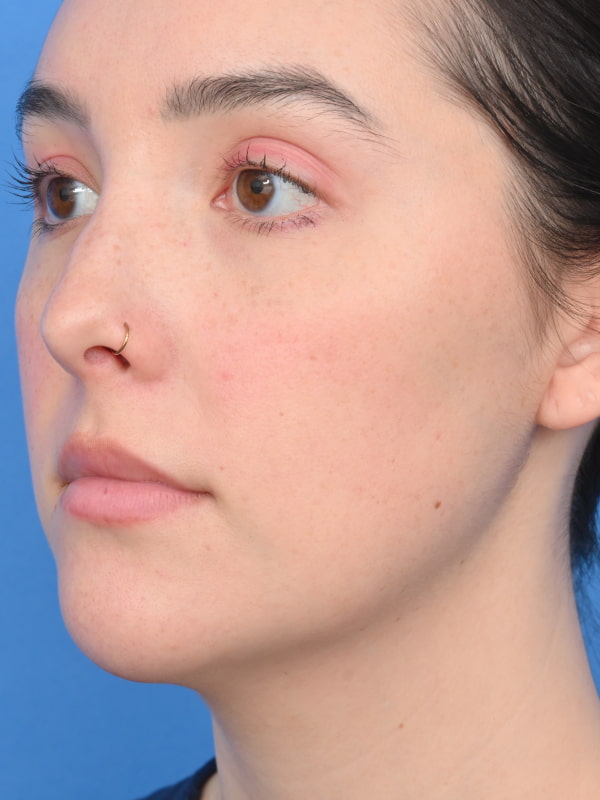 Neck Liposuction Before & After Image