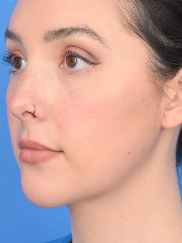 Neck Liposuction Before & After Image