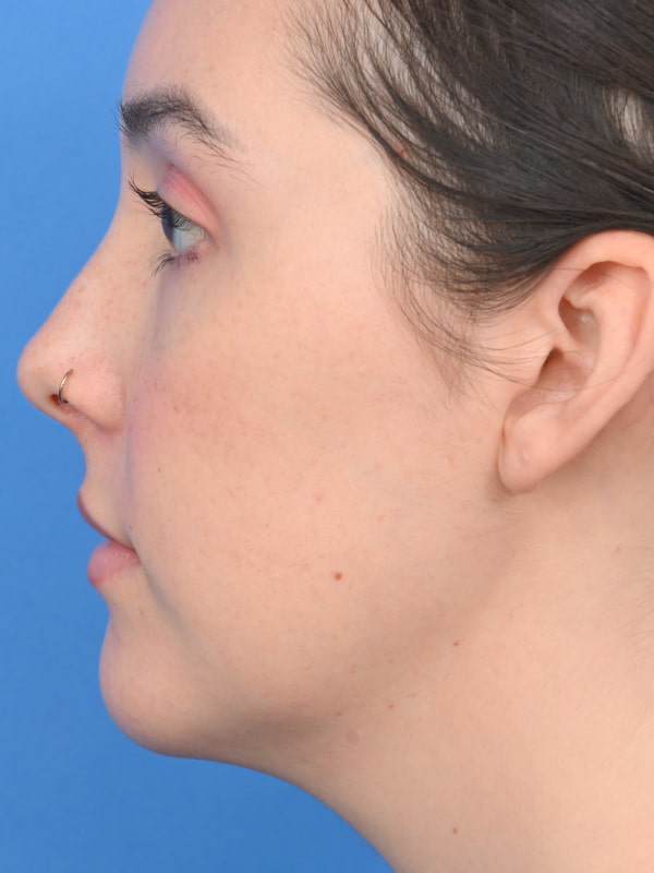 Neck Liposuction Before & After Image