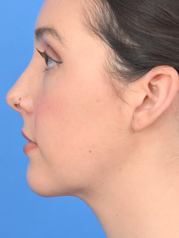 Neck Liposuction Before & After Image