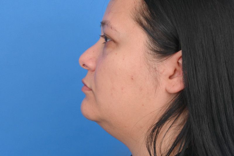 Neck Liposuction Before & After Image