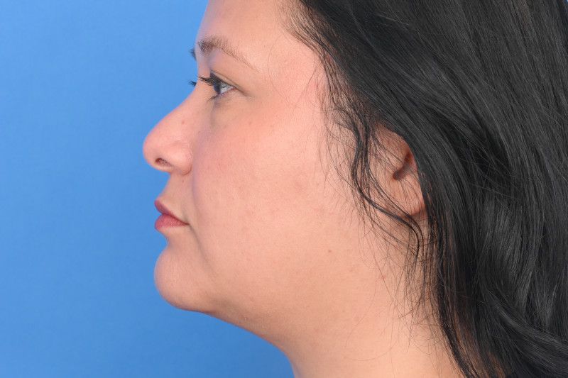 Neck Liposuction Before & After Image