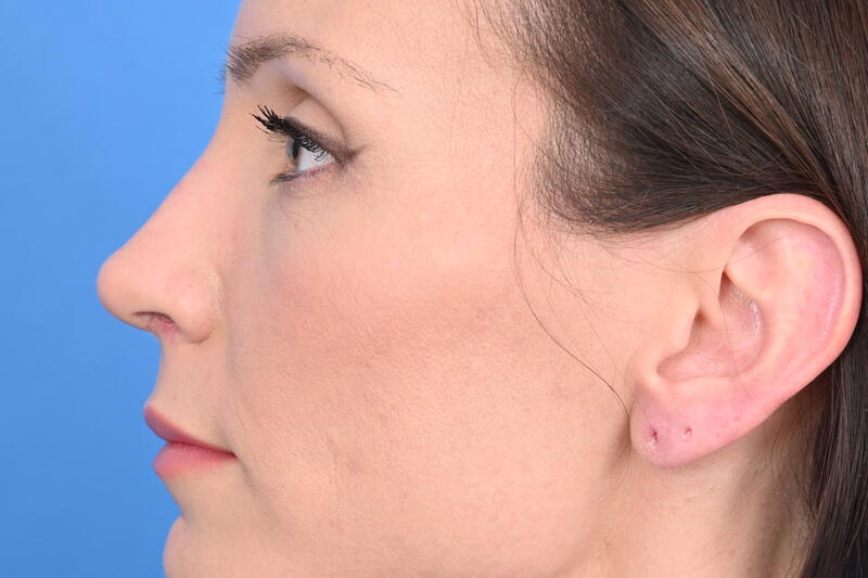 Rhinoplasty Before & After Image