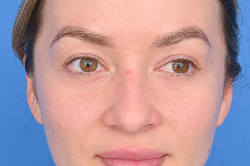 Rhinoplasty Before & After Image
