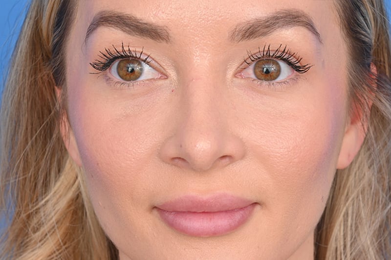 Rhinoplasty Before & After Image