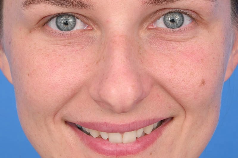 Rhinoplasty Before & After Image