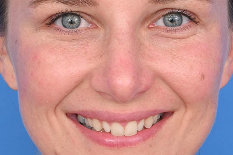 Rhinoplasty Before & After Image