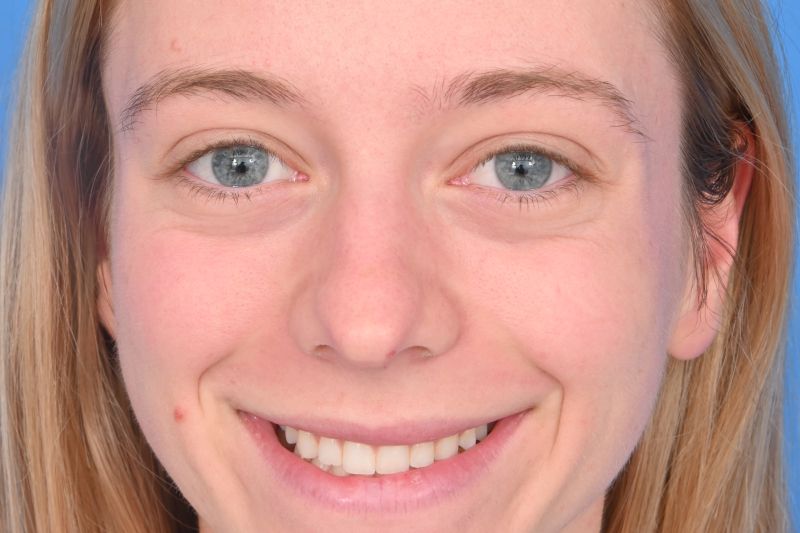 Rhinoplasty Before & After Image
