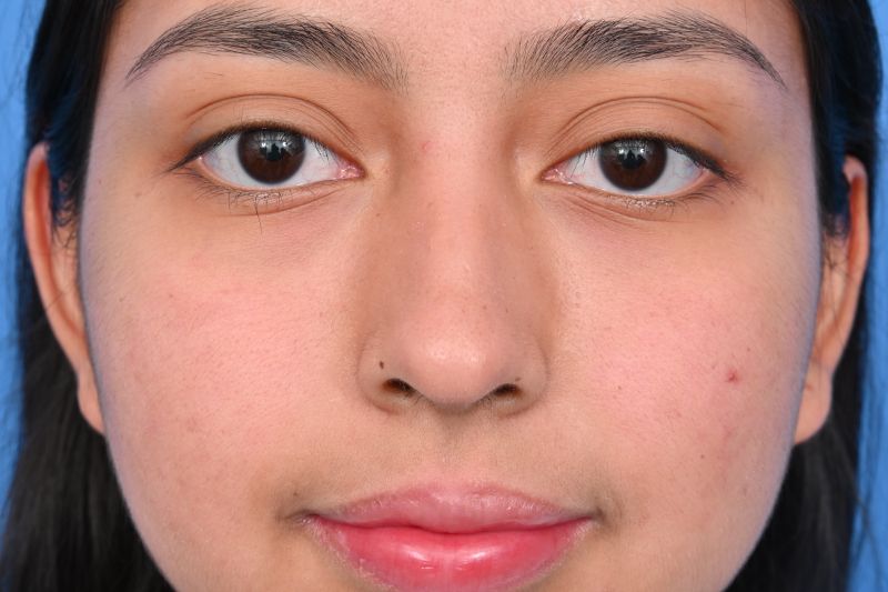 Rhinoplasty Before & After Image