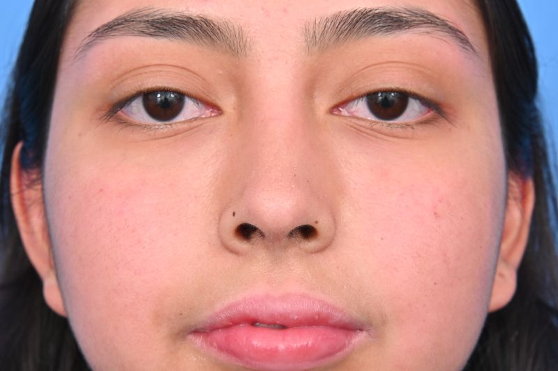 Rhinoplasty Before & After Image