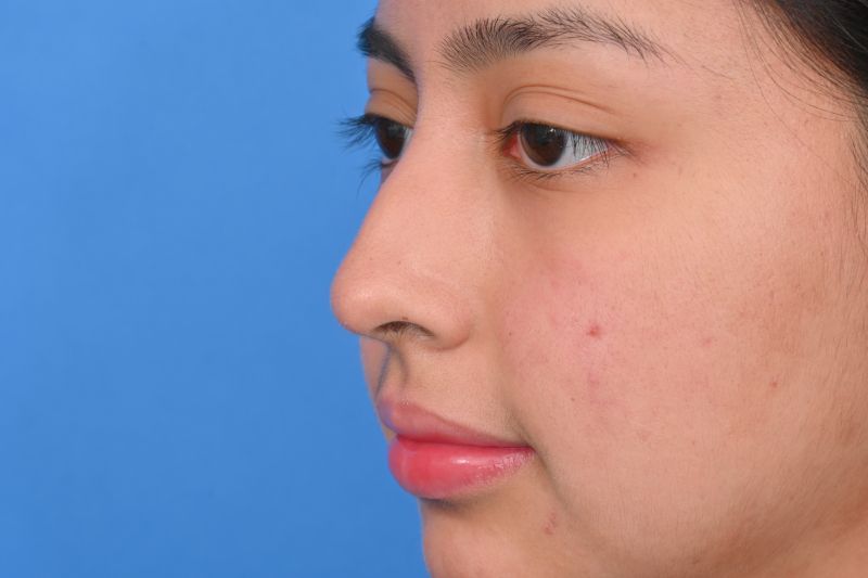 Rhinoplasty Before & After Image