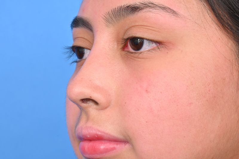 Rhinoplasty Before & After Image