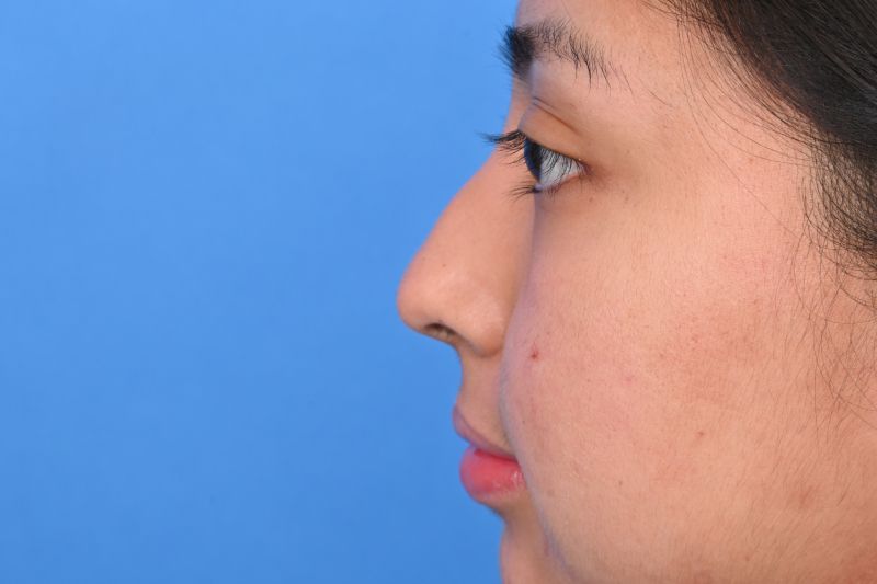 Rhinoplasty Before & After Image