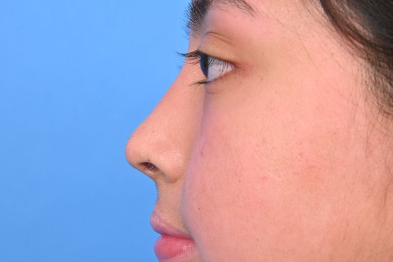 Rhinoplasty Before & After Image