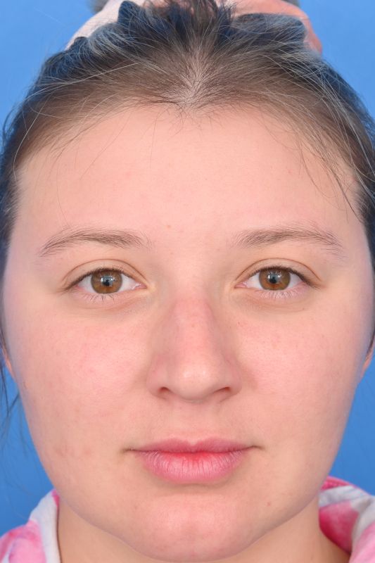 Rhinoplasty Before & After Image