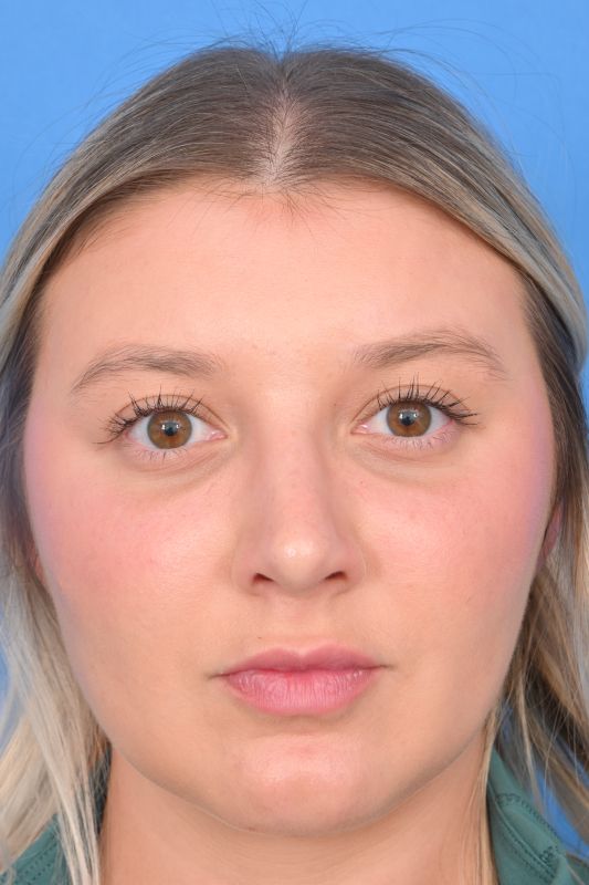 Rhinoplasty Before & After Image