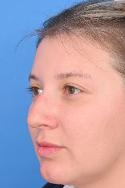 Rhinoplasty Before & After Image